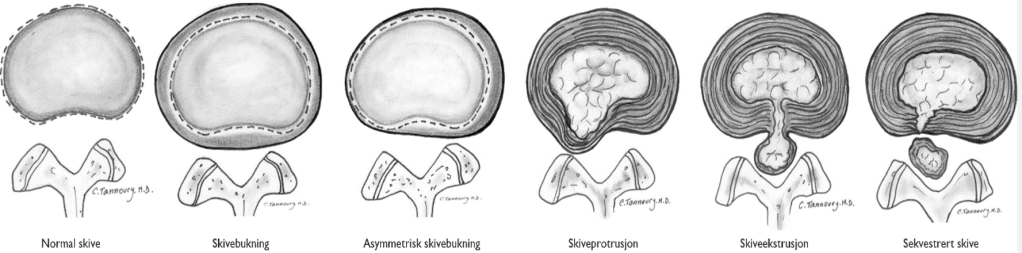 Lumbal skiveprolaps – Del 1: Hva er&nbsp;prolaps?